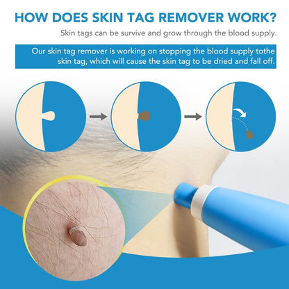 Skin Tag Remover